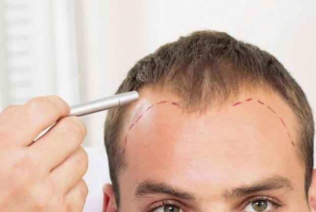 DHI Haartransplantation